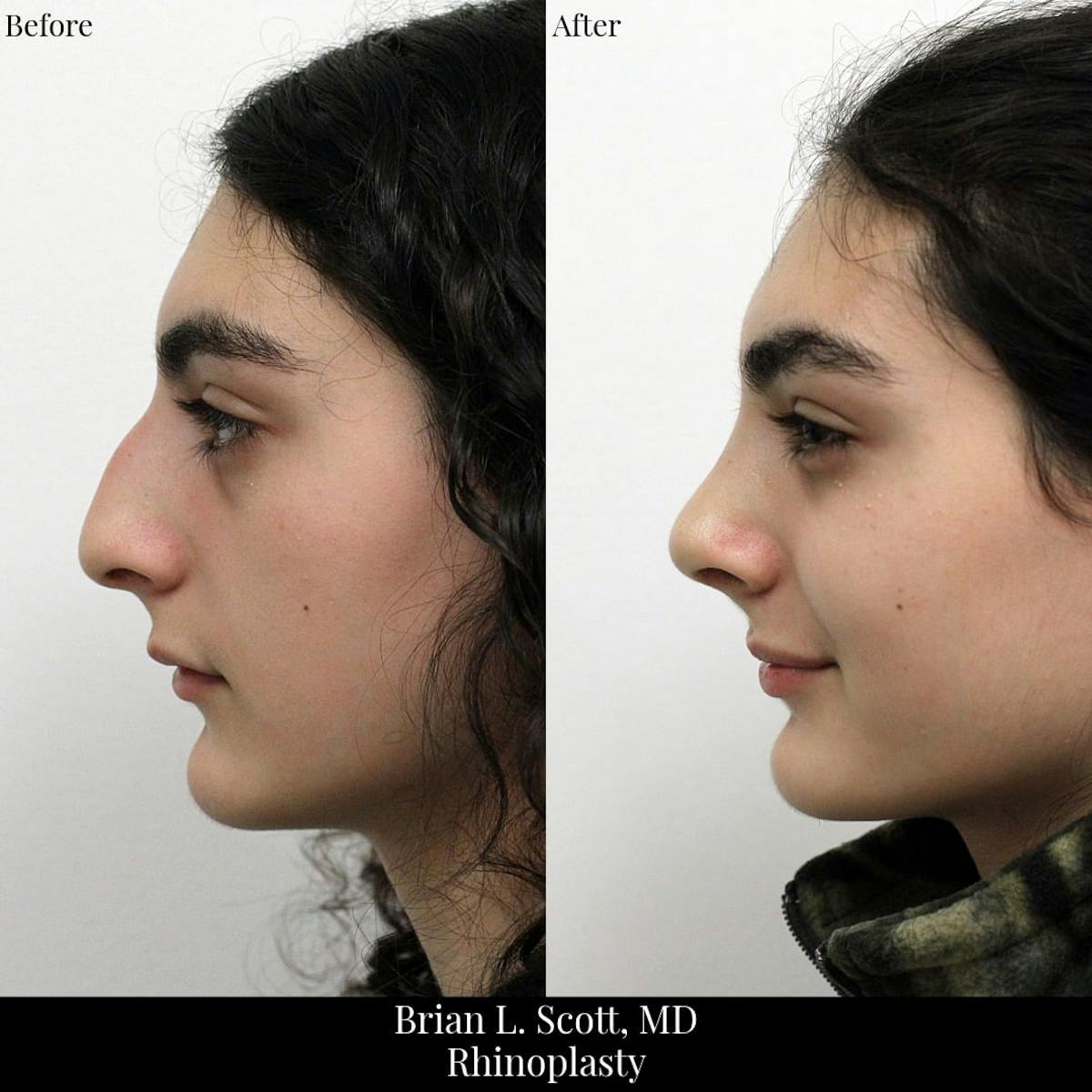 Rhinoplasty Before & After Gallery - Patient 258403 - Image 1