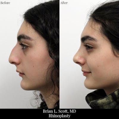 Rhinoplasty Before & After Gallery - Patient 258403 - Image 1
