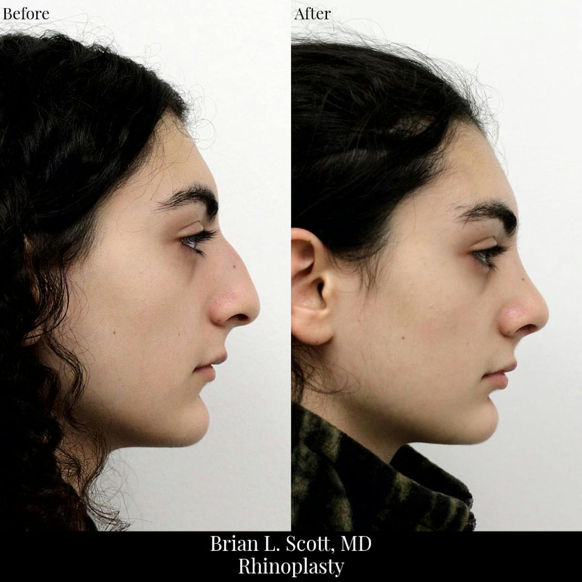 Rhinoplasty Before & After Gallery - Patient 258403 - Image 5