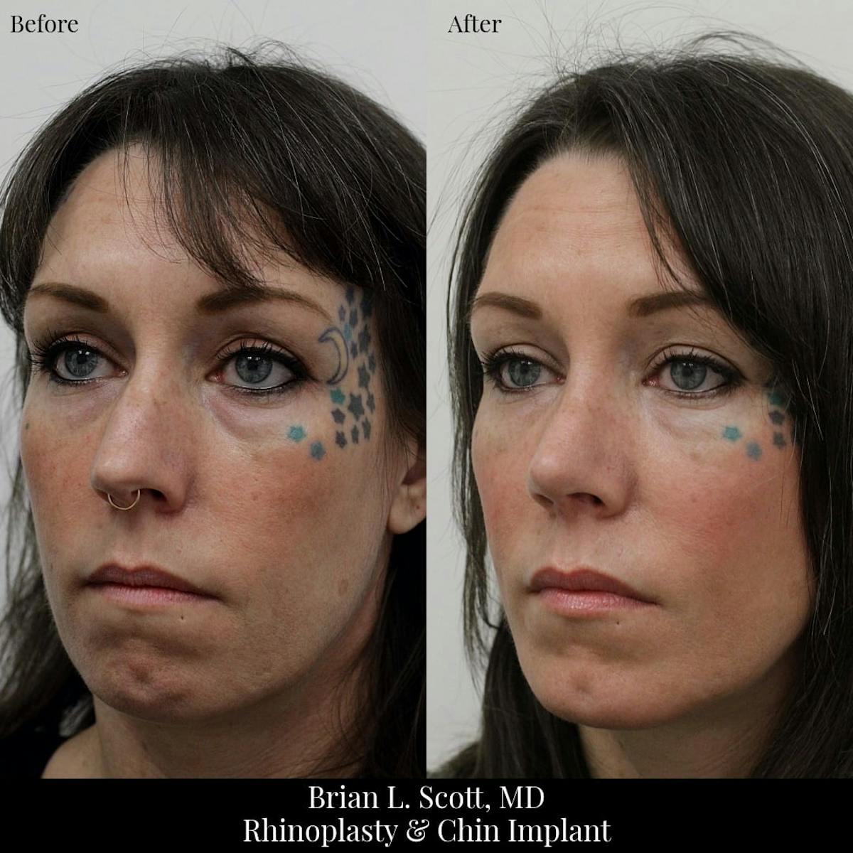 Rhinoplasty Before & After Gallery - Patient 761719 - Image 1