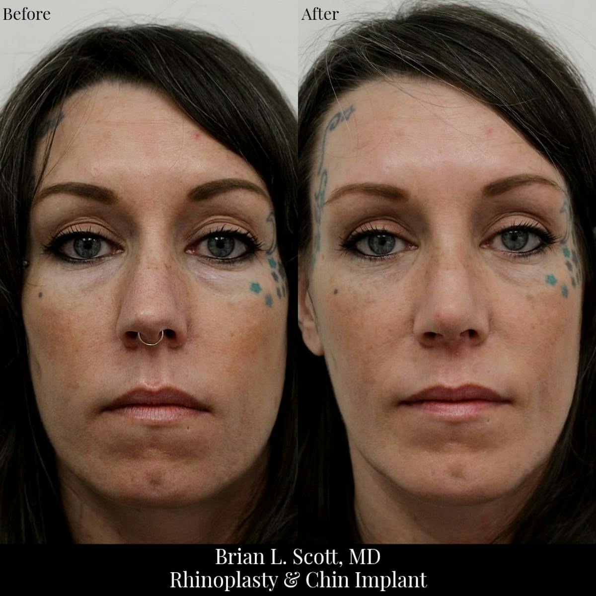 Rhinoplasty Before & After Gallery - Patient 761719 - Image 2