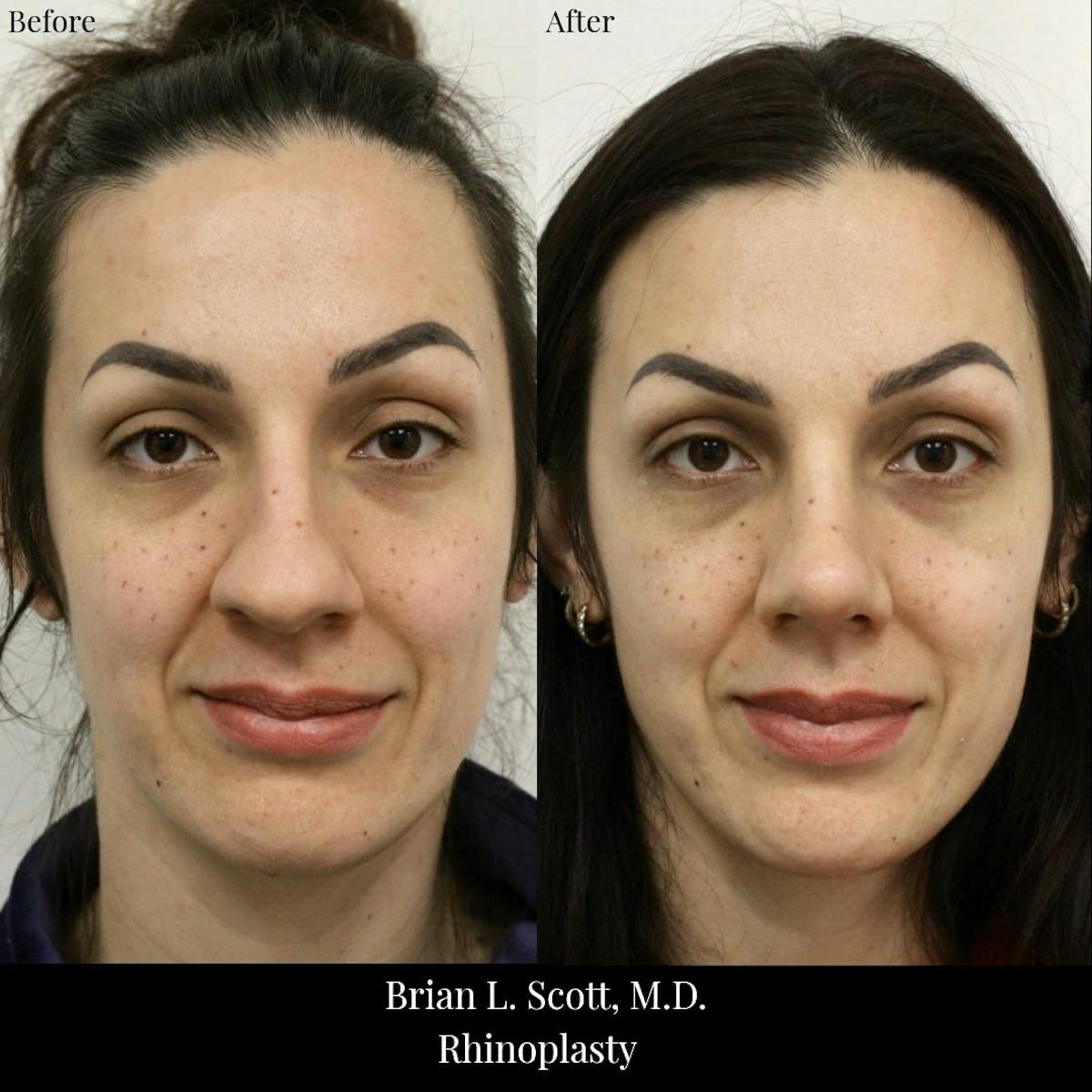 Rhinoplasty Before & After Gallery - Patient 204529 - Image 2