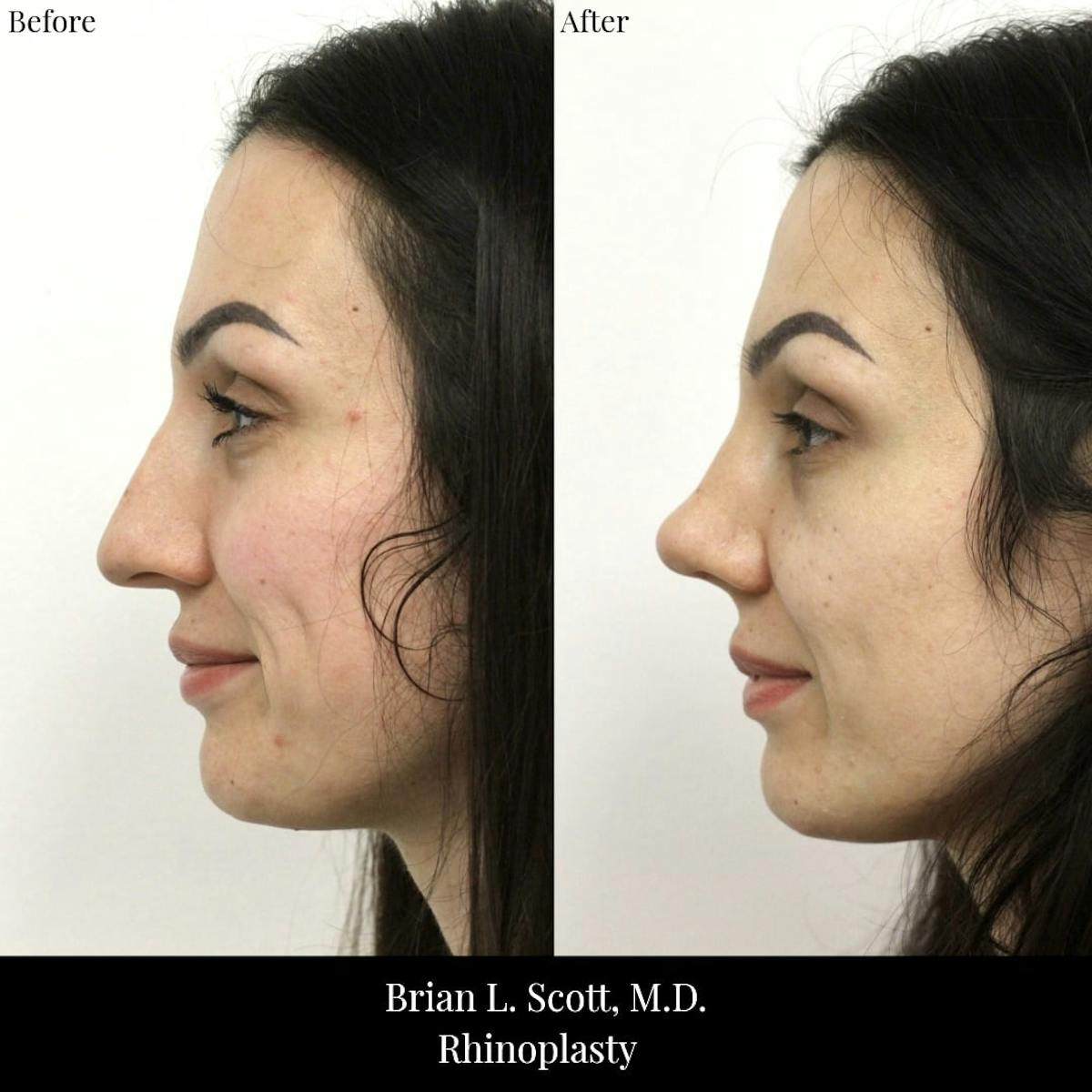 Rhinoplasty Before & After Gallery - Patient 204529 - Image 4