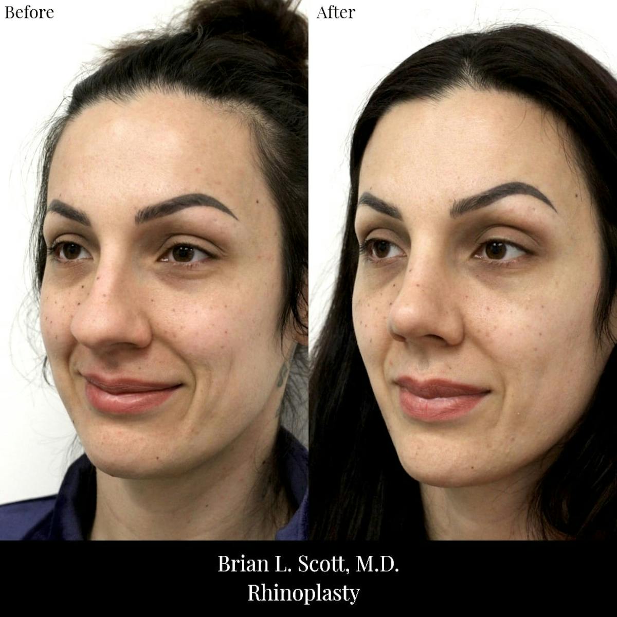 Rhinoplasty Before & After Gallery - Patient 204529 - Image 3
