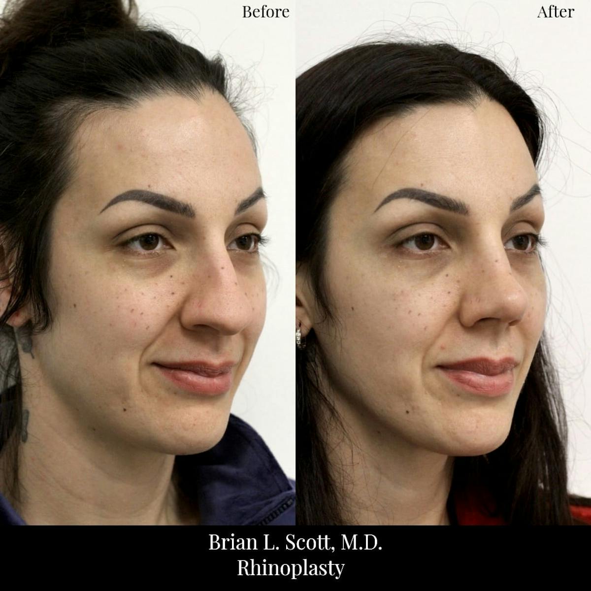 Rhinoplasty Before & After Gallery - Patient 204529 - Image 1
