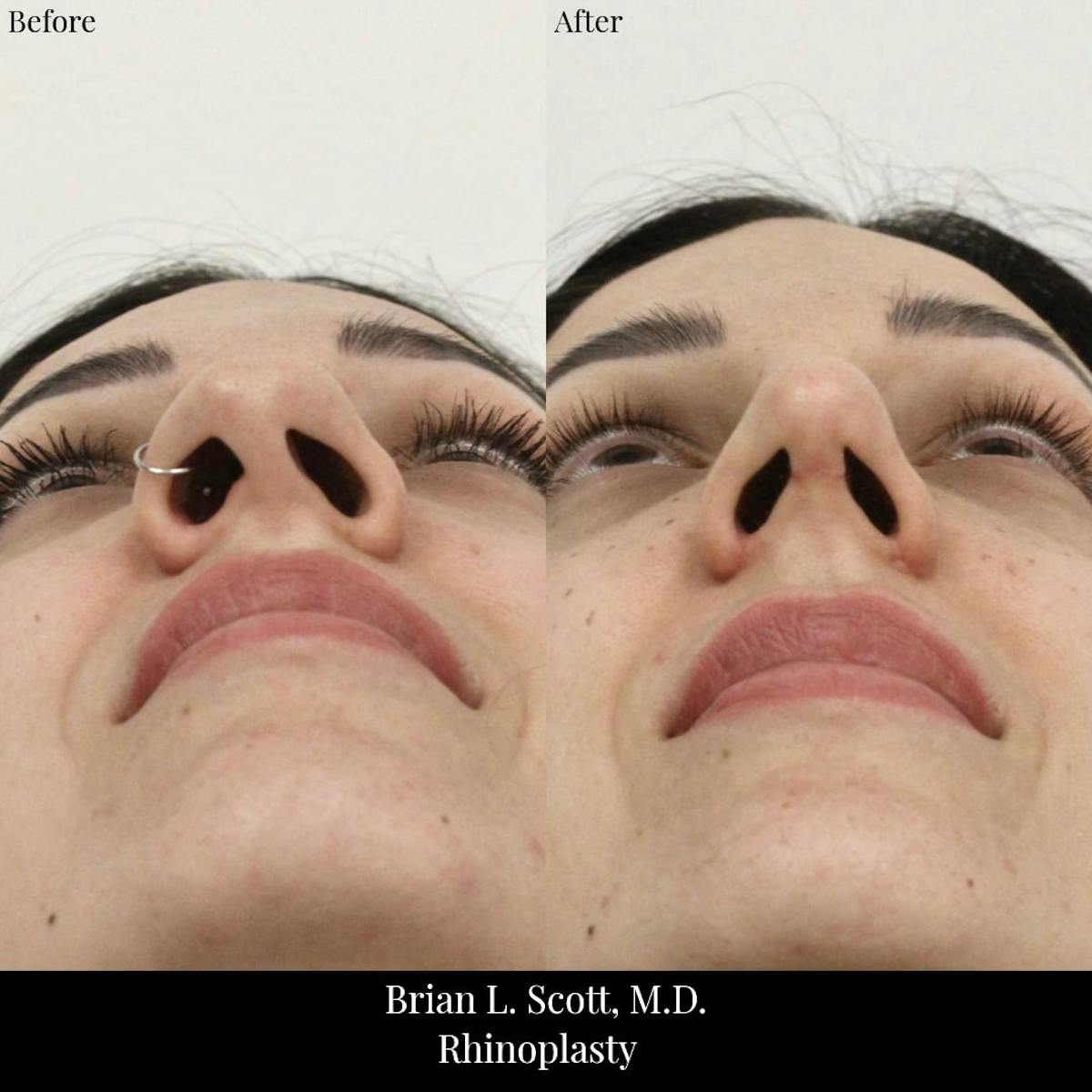 Rhinoplasty Before & After Gallery - Patient 204529 - Image 5