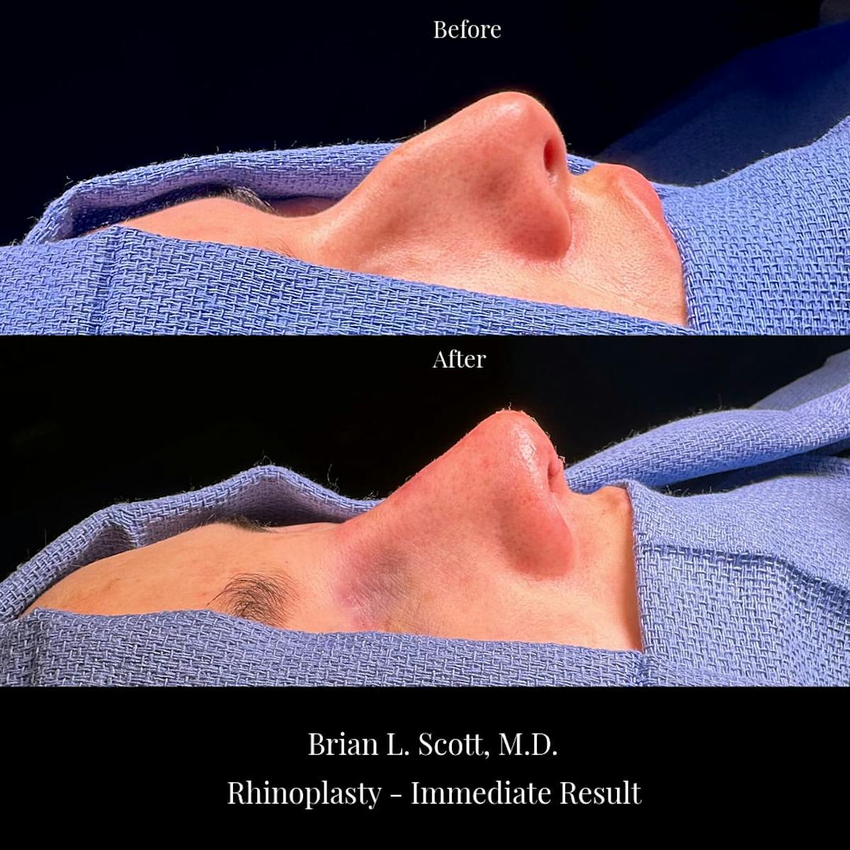Rhinoplasty Before & After Gallery - Patient 426356 - Image 2