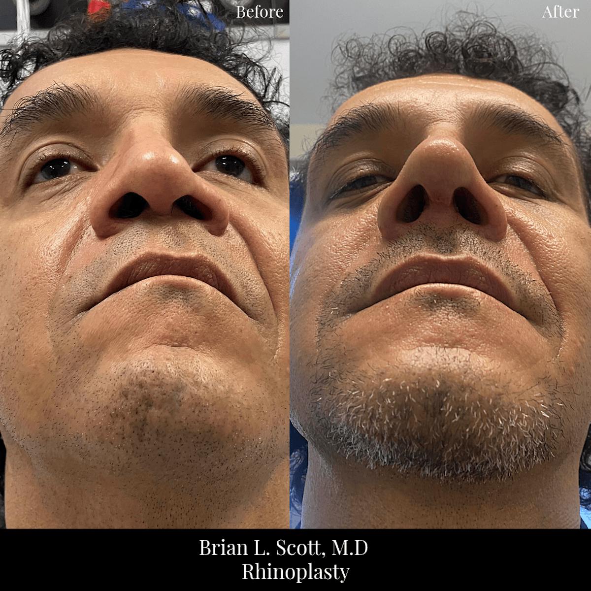 Rhinoplasty Before & After Gallery - Patient 426356 - Image 1