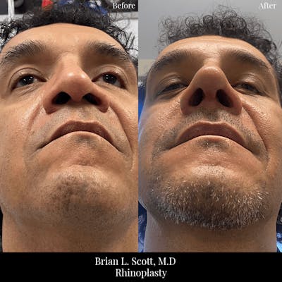 Rhinoplasty Before & After Gallery - Patient 426356 - Image 1