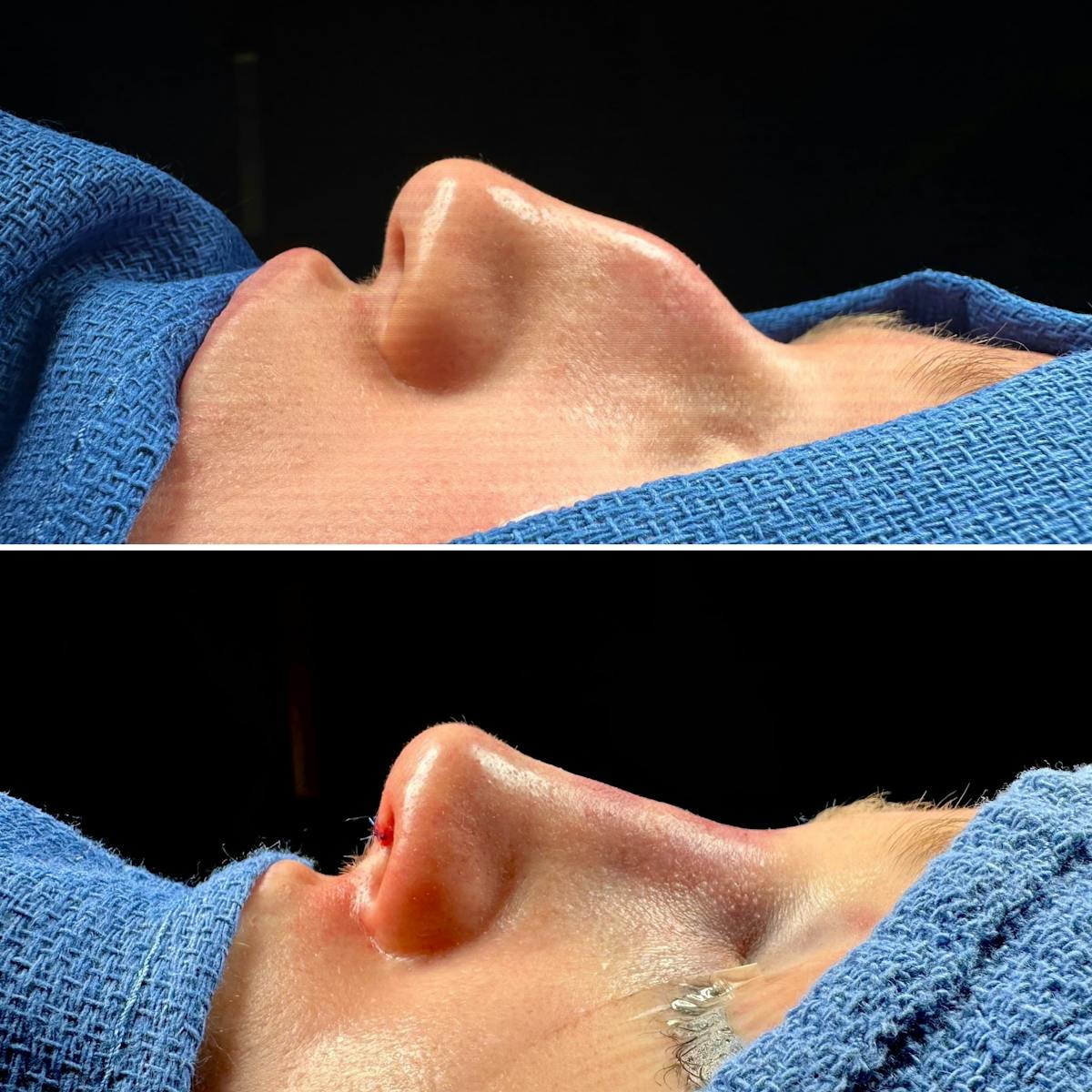 Rhinoplasty Before & After Gallery - Patient 426356 - Image 3