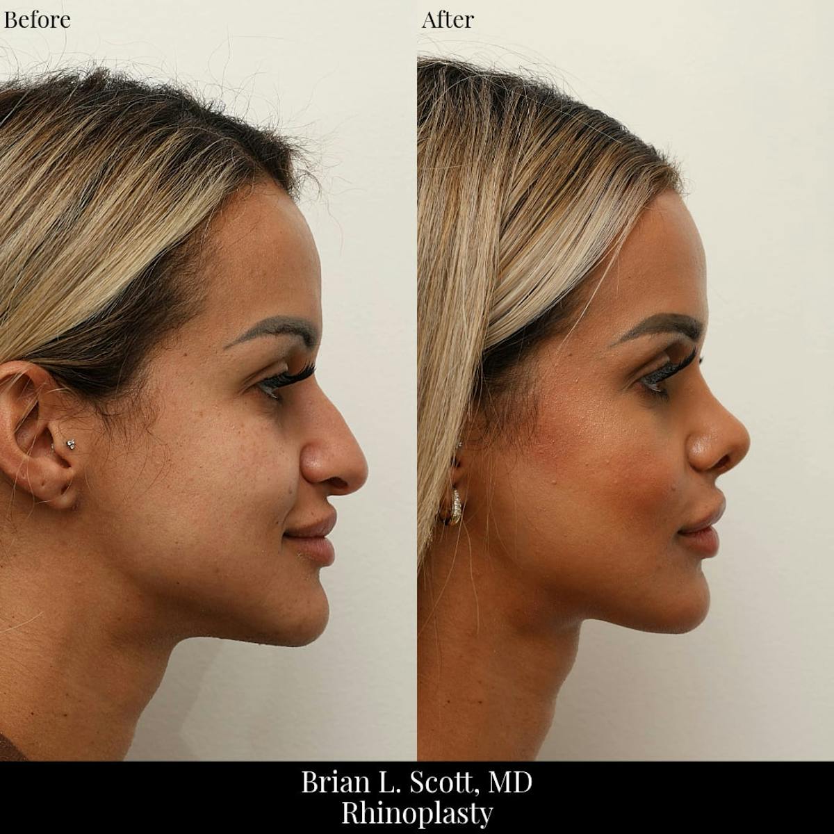 Rhinoplasty Before & After Gallery - Patient 248599 - Image 1