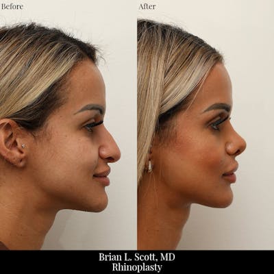 Rhinoplasty Before & After Gallery - Patient 248599 - Image 1
