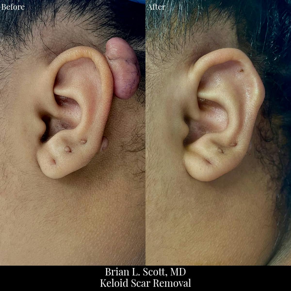 Scar Revision Before & After Gallery - Patient 754442 - Image 1