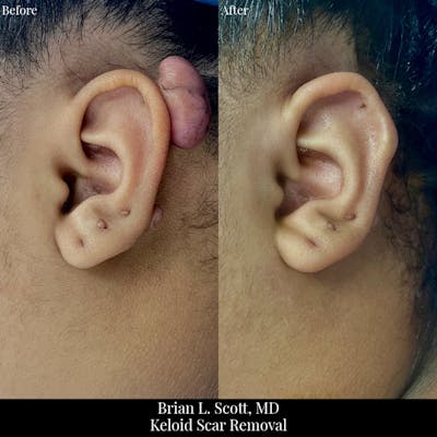 Scar Revision Before & After Gallery - Patient 754442 - Image 1