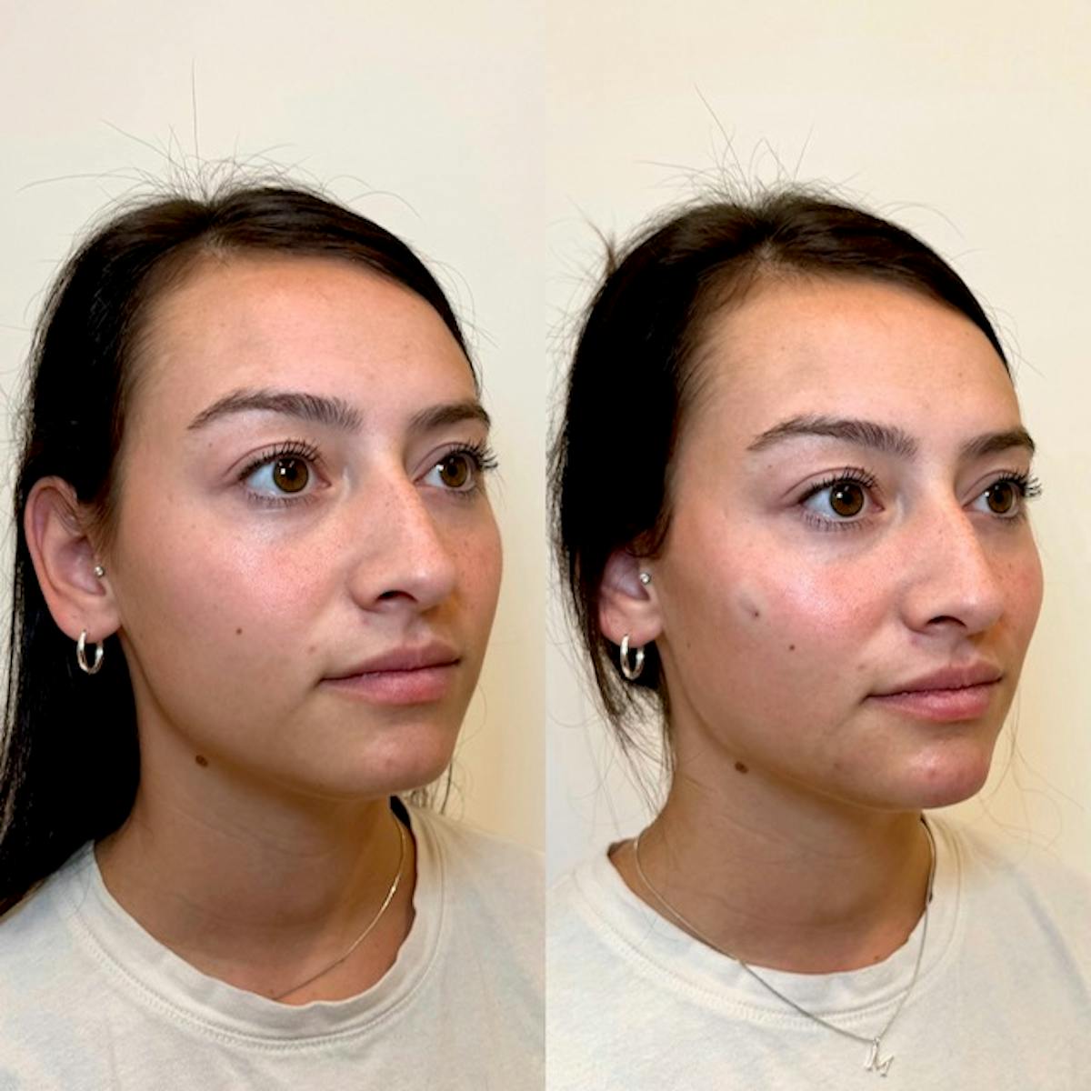 Fillers Before & After Gallery - Patient 242762 - Image 2