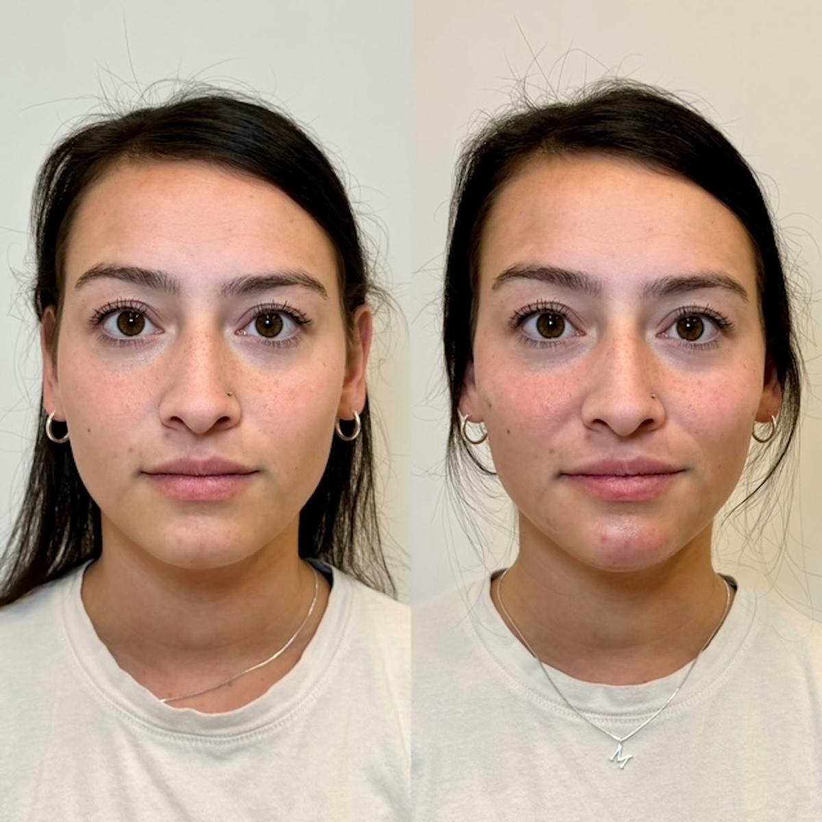 Fillers Before & After Gallery - Patient 242762 - Image 1