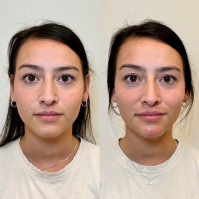 Fillers Before & After Gallery - Patient 242762 - Image 1