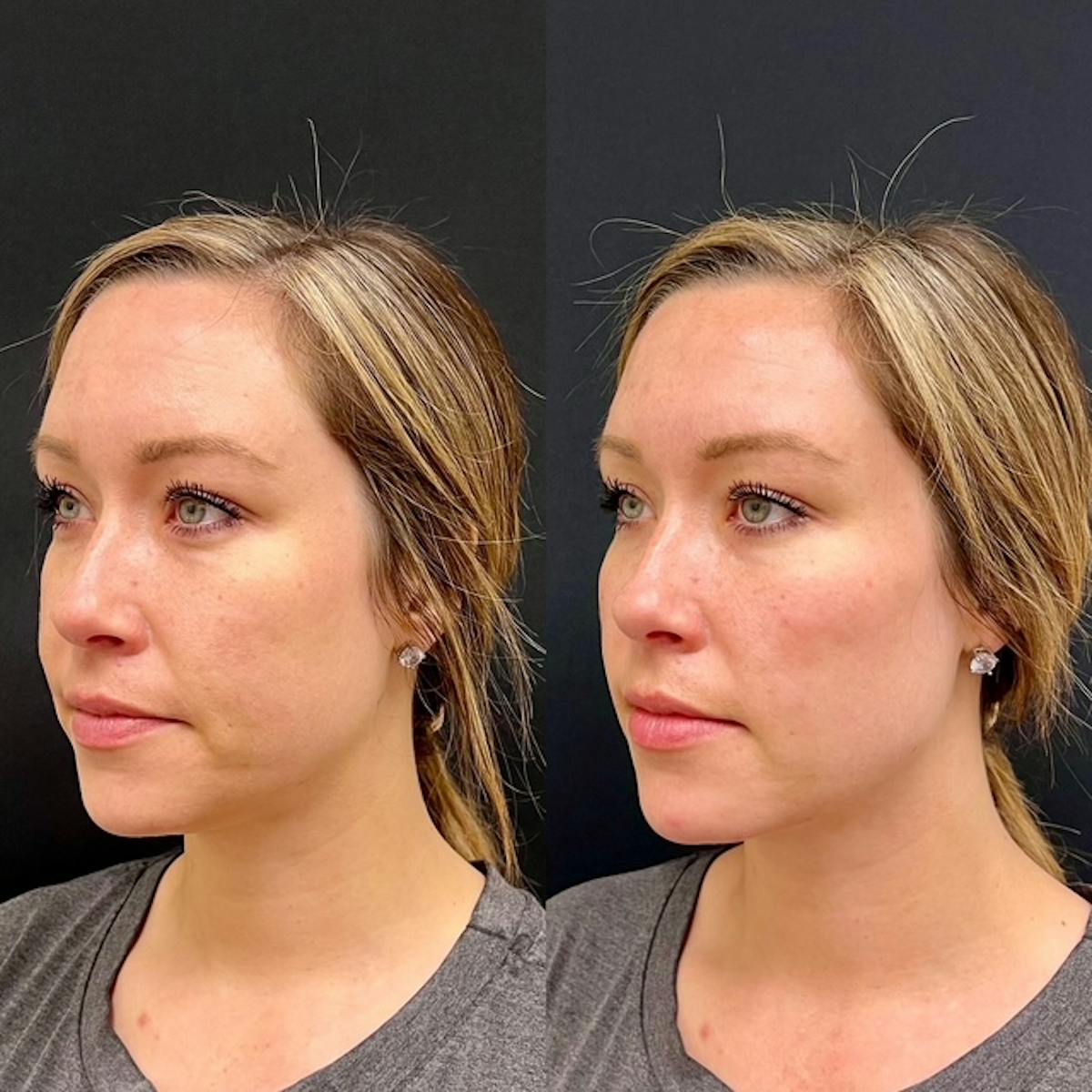 Fillers Before & After Gallery - Patient 285996 - Image 1