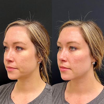 Fillers Before & After Gallery - Patient 285996 - Image 1