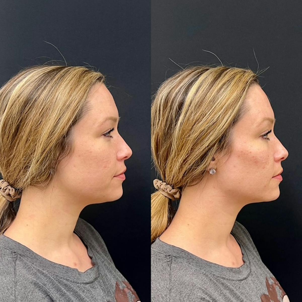 Fillers Before & After Gallery - Patient 285996 - Image 2
