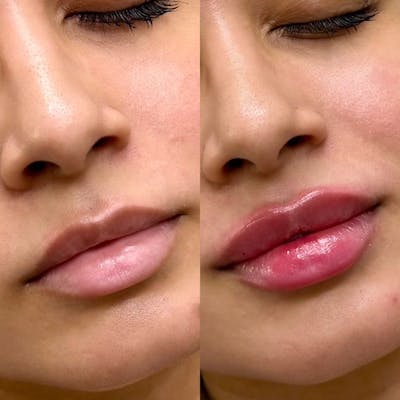 Fillers Before & After Gallery - Patient 106325 - Image 1