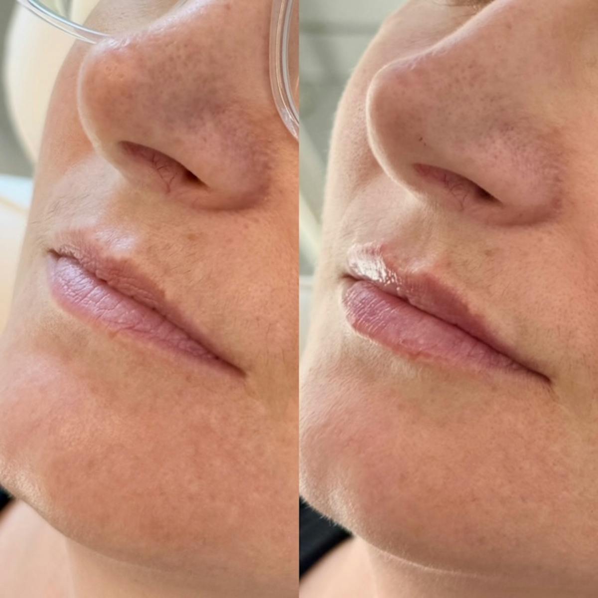 Fillers Before & After Gallery - Patient 259125 - Image 1