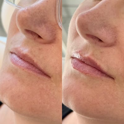 Fillers Before & After Gallery - Patient 259125 - Image 1