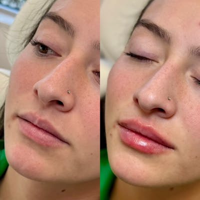 Fillers Before & After Gallery - Patient 196926 - Image 1