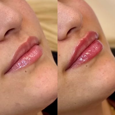 Fillers Before & After Gallery - Patient 732799 - Image 1