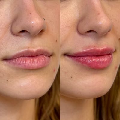 Fillers Before & After Gallery - Patient 267199 - Image 1