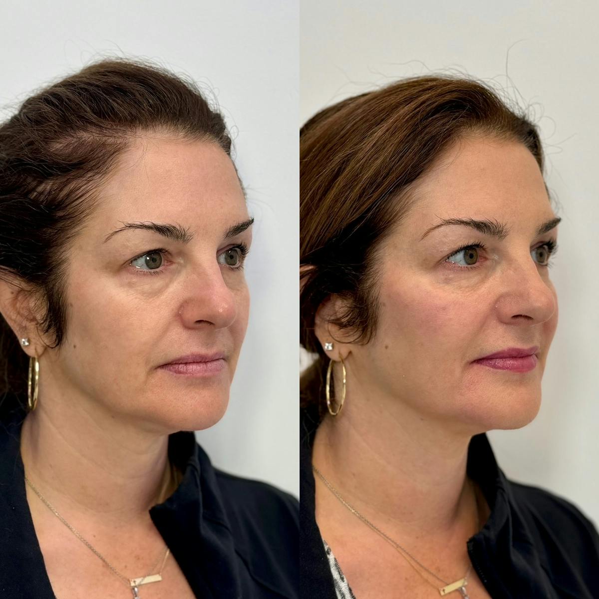 Fillers Before & After Gallery - Patient 133155 - Image 3