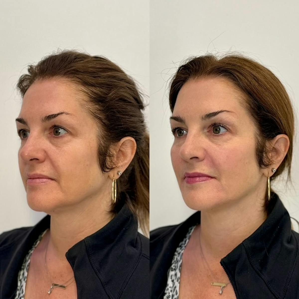 Fillers Before & After Gallery - Patient 133155 - Image 2