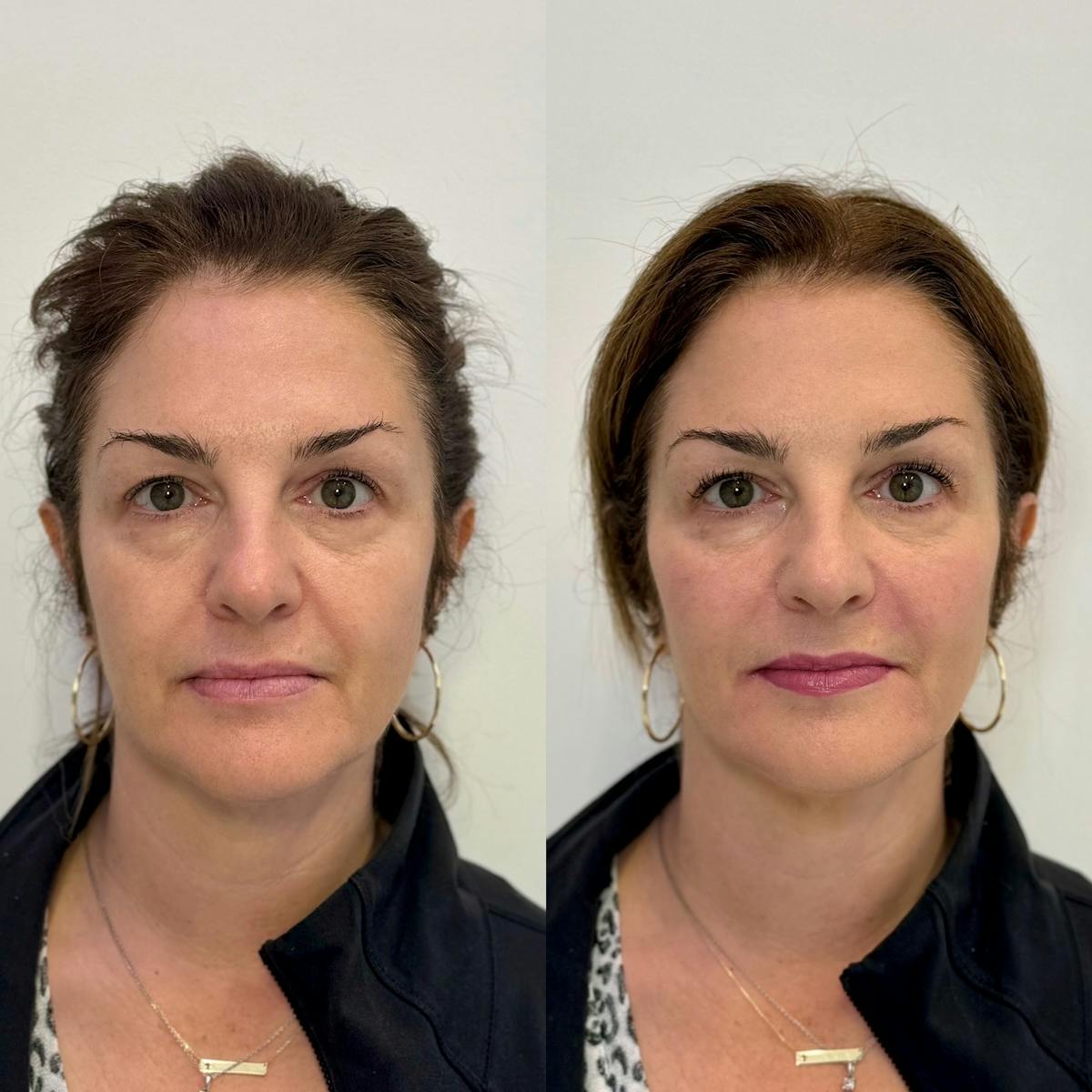 Fillers Before & After Gallery - Patient 133155 - Image 1