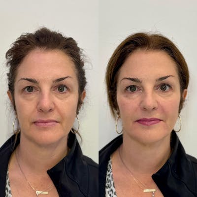 Fillers Before & After Gallery - Patient 133155 - Image 1