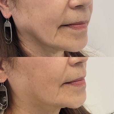 Fillers Before & After Gallery - Patient 212829 - Image 1