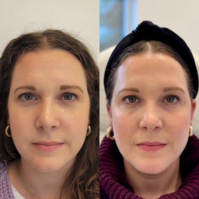 Daxxify Before & After Gallery - Patient 313168 - Image 1