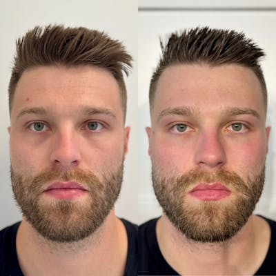 BOTOX Before & After Gallery - Patient 264664 - Image 1
