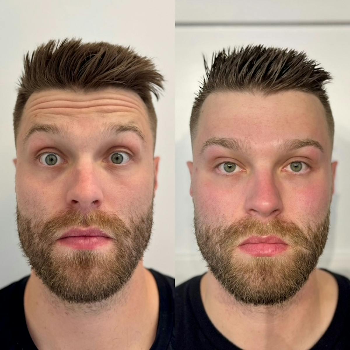BOTOX Before & After Gallery - Patient 264664 - Image 2