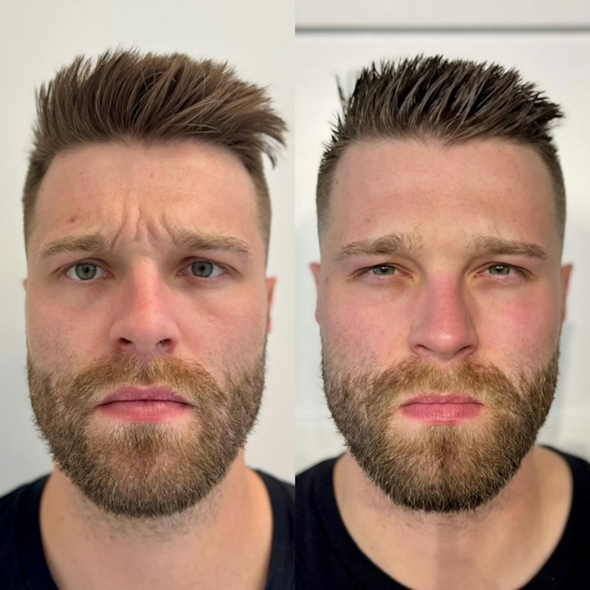 BOTOX Before & After Gallery - Patient 264664 - Image 3