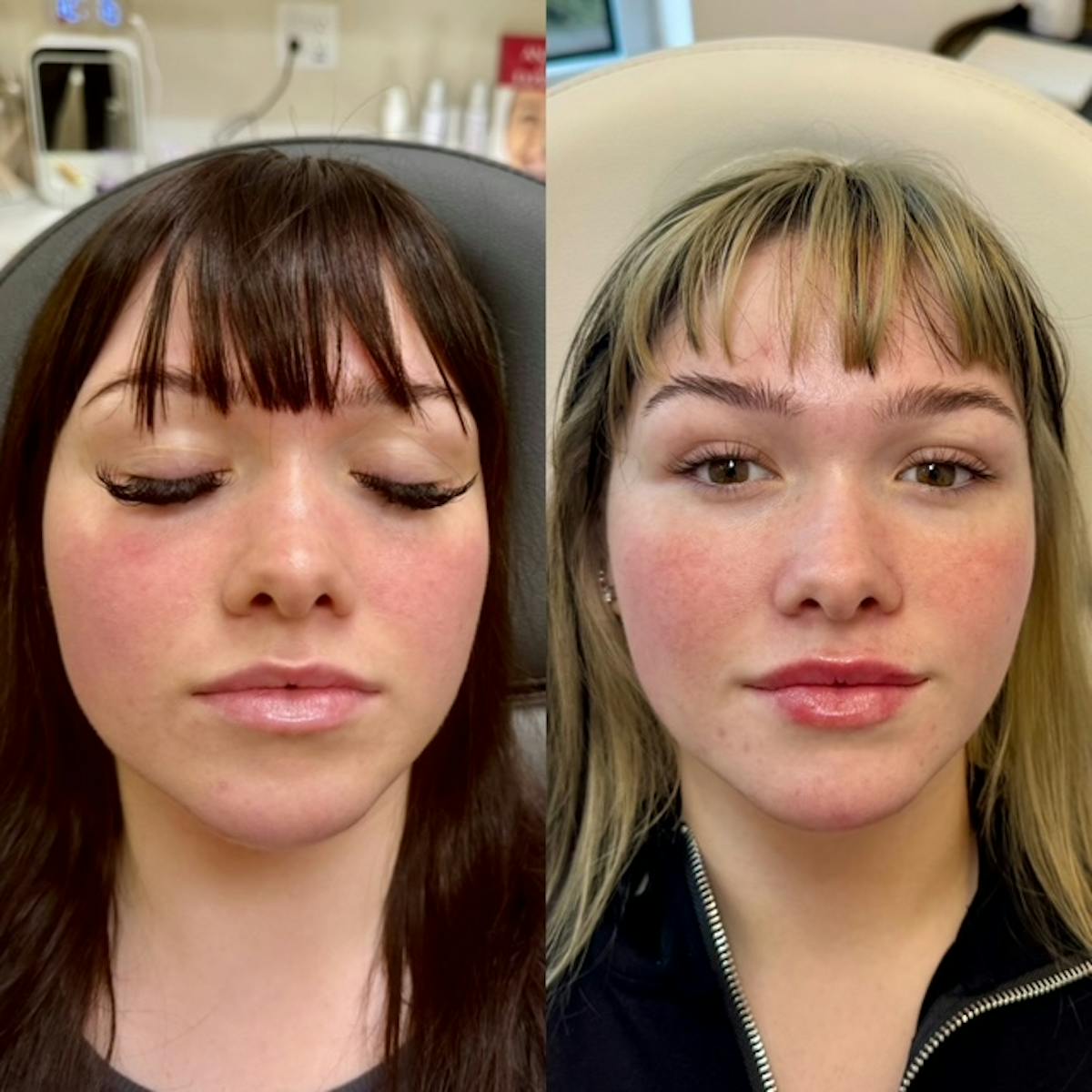BOTOX Before & After Gallery - Patient 303905 - Image 1