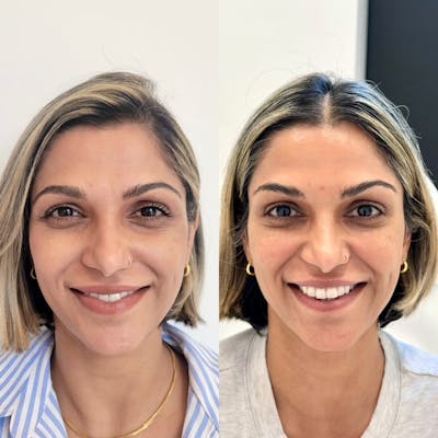 BOTOX Before & After Gallery - Patient 171123 - Image 1