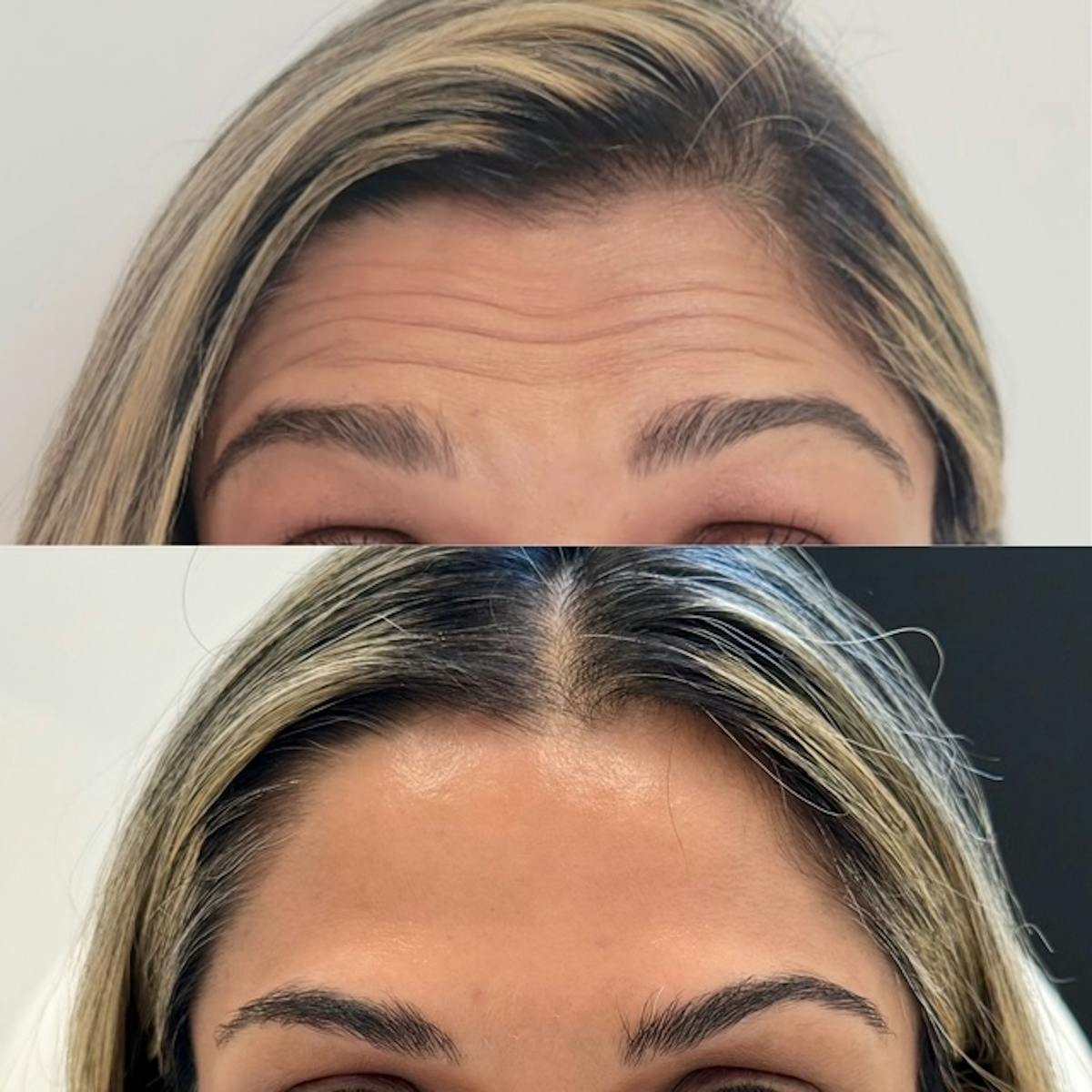 BOTOX Before & After Gallery - Patient 258090 - Image 1