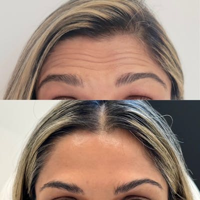 BOTOX Before & After Gallery - Patient 258090 - Image 1