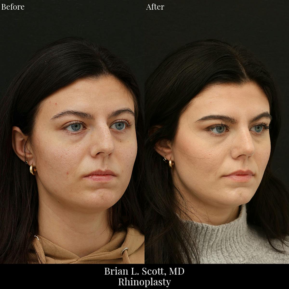 Rhinoplasty Before & After Gallery - Patient 400985 - Image 2