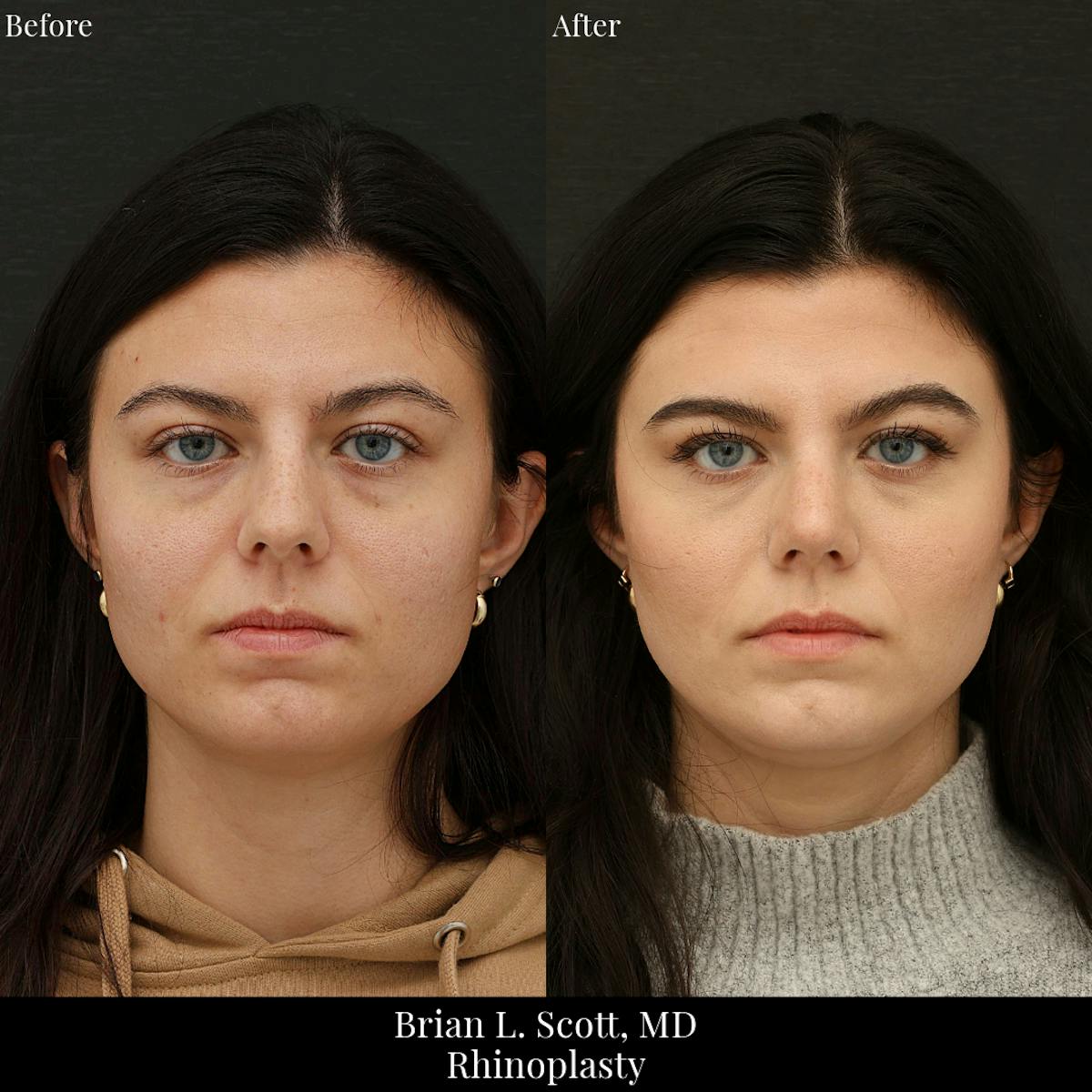 Rhinoplasty Before & After Gallery - Patient 400985 - Image 3