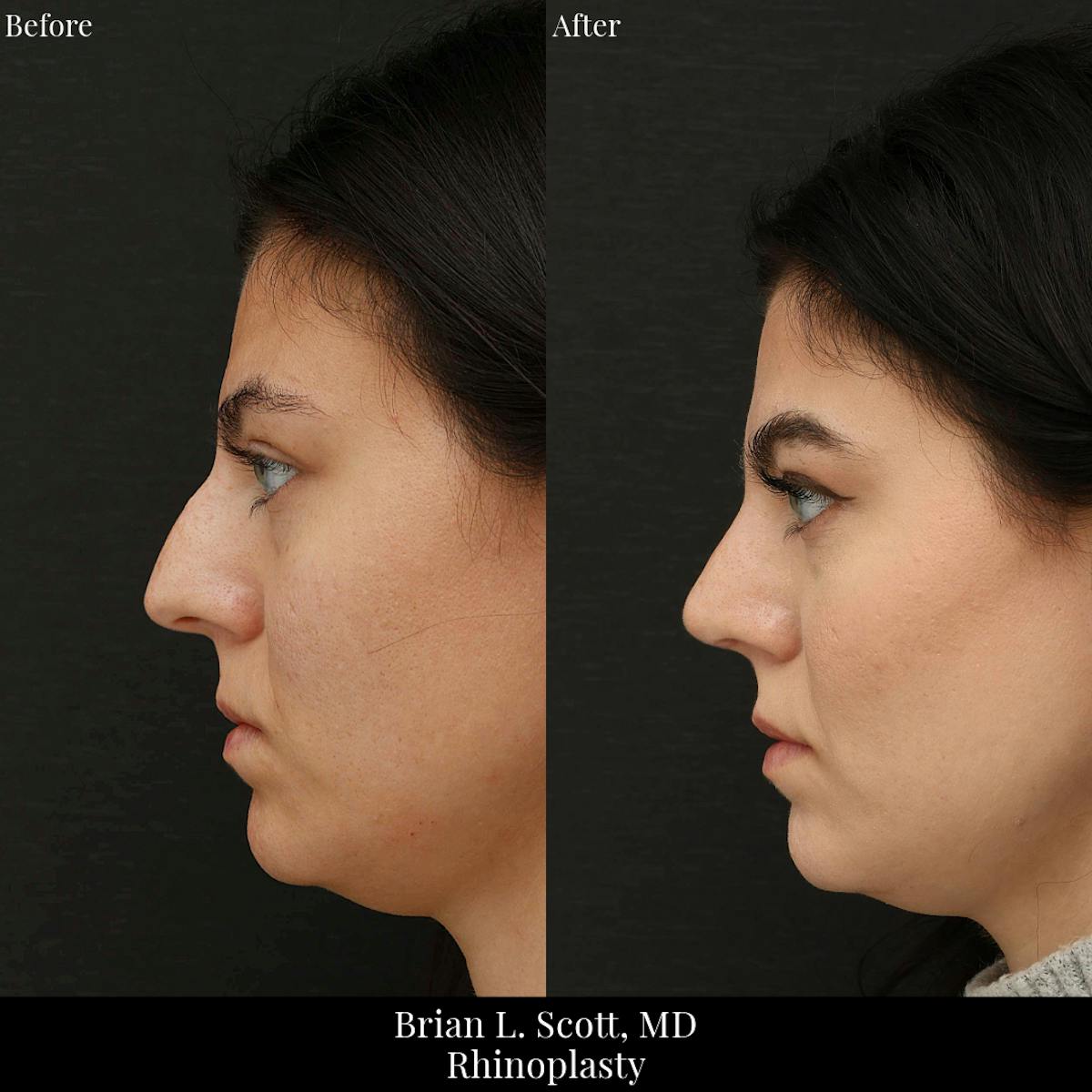Rhinoplasty Before & After Gallery - Patient 400985 - Image 1