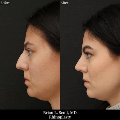 Rhinoplasty Before & After Gallery - Patient 400985 - Image 1