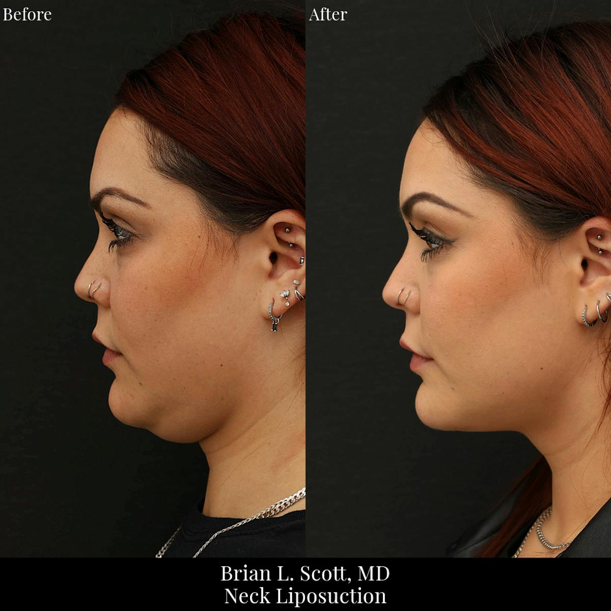 Neck Liposuction Before & After Gallery - Patient 186923 - Image 1