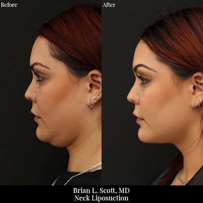 Neck Liposuction Before & After Gallery - Patient 186923 - Image 1