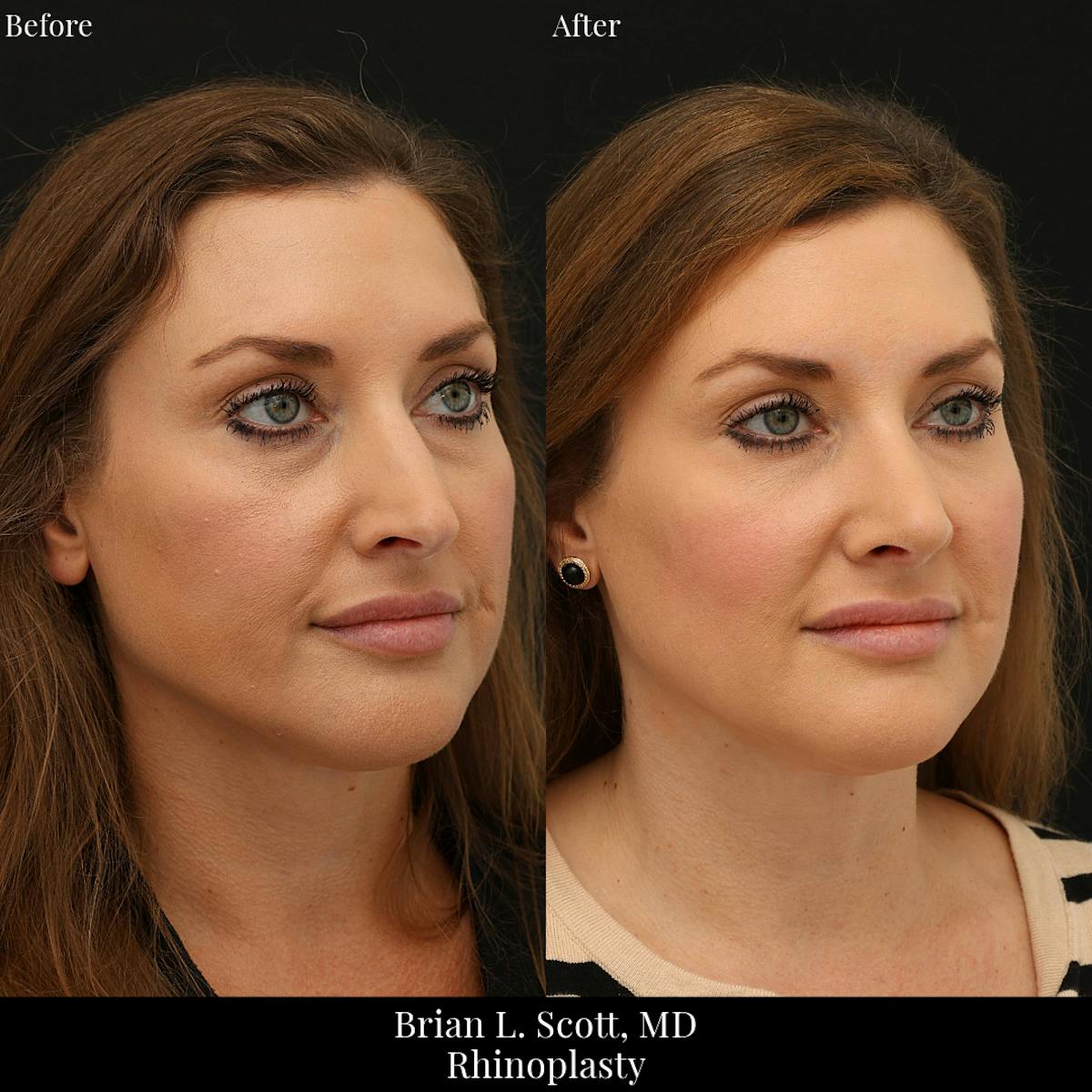 Rhinoplasty Before & After Gallery - Patient 175874 - Image 3